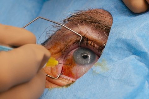 Injections intravitréennes (IVT)