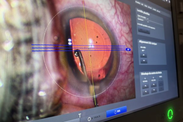 Implant torique : pourquoi chaque degré compte